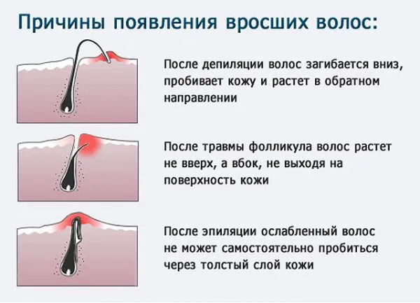 Модели удаления волос